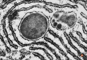 F,52y. | inclusions in the endoplasmic reticulum - plasmocytoma